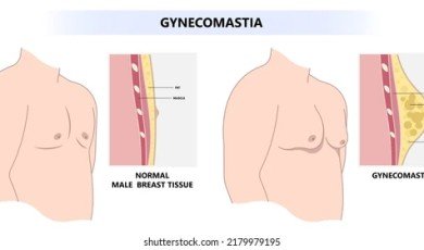 Gynecomastia